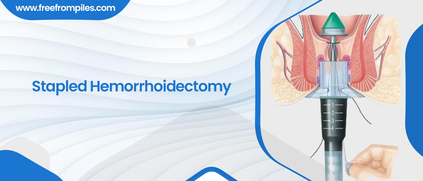 Stapled Hemorrhoidectomy