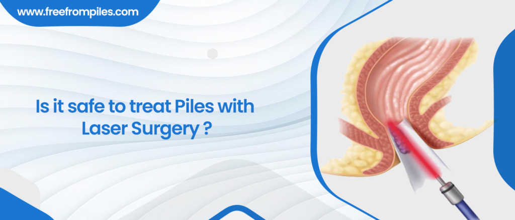 Piles Laser Surgery