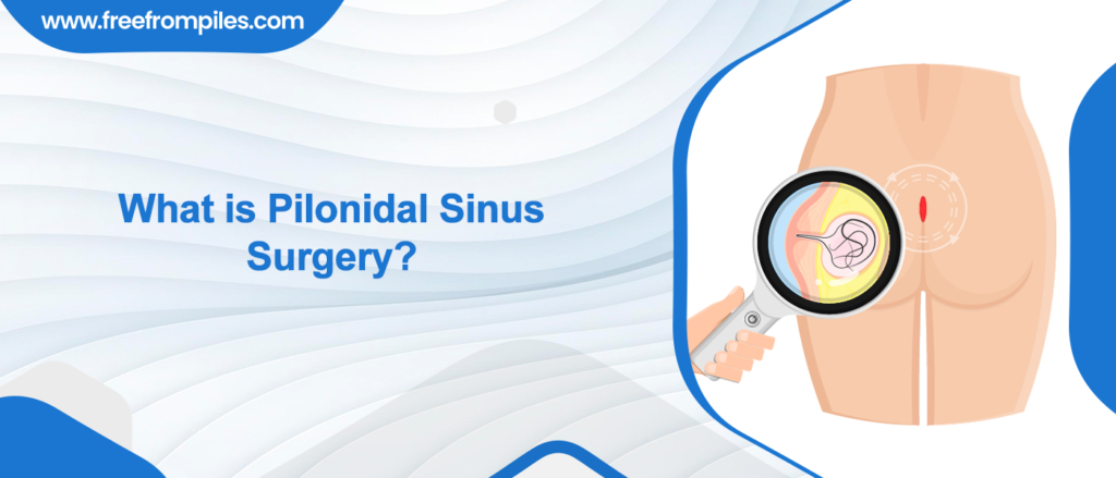 What is pilonidal sinus surgery?