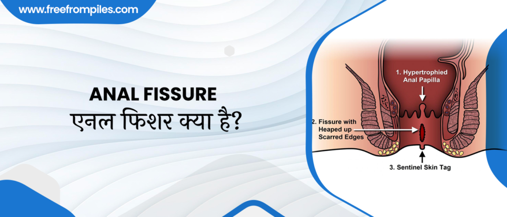 Anal Fissure in Hindi