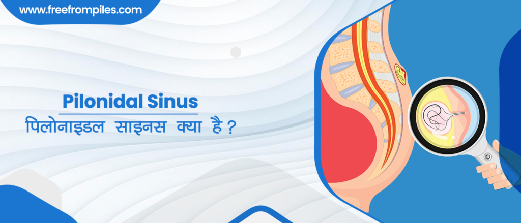 Pilonidal Sinus in Hindi