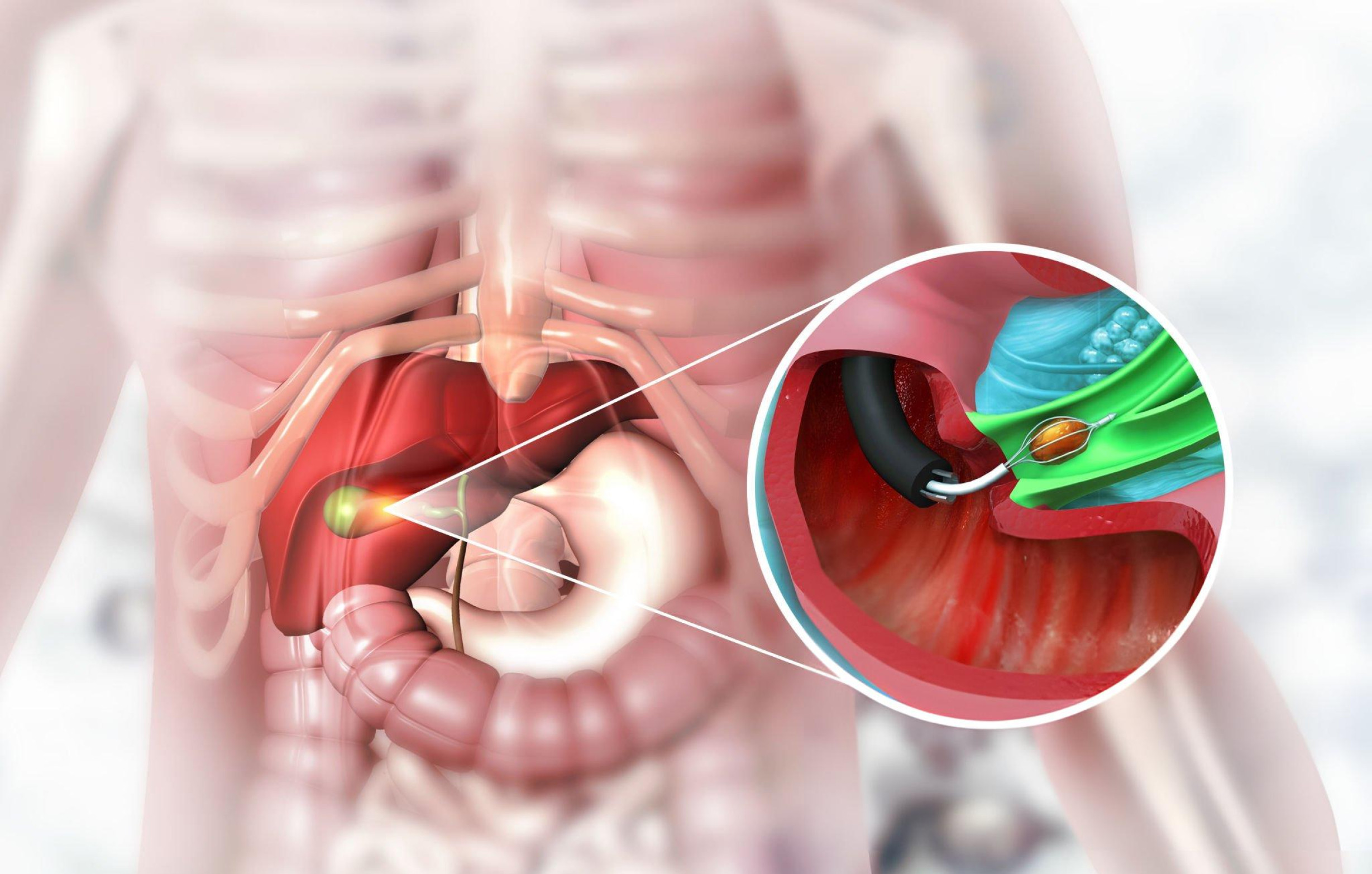 Diagnosing Gallstones