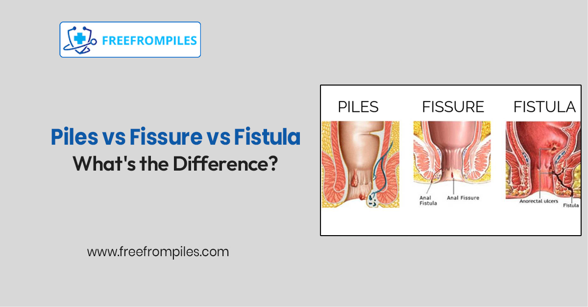 Piles vs Fissure vs Fistula: What’s the Difference?